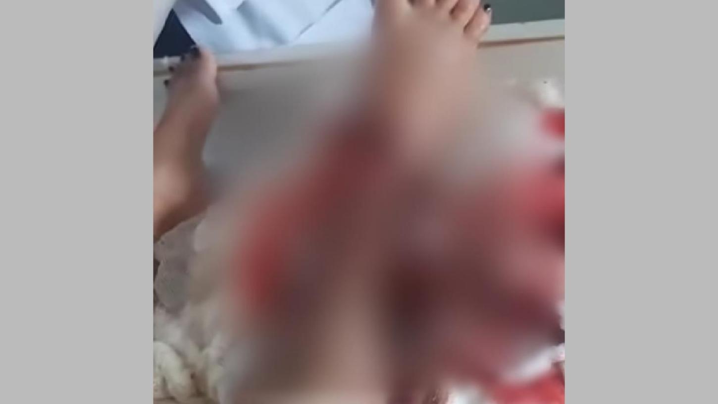 Família faz “vaquinha” para custear tratamento de jovem atropelada