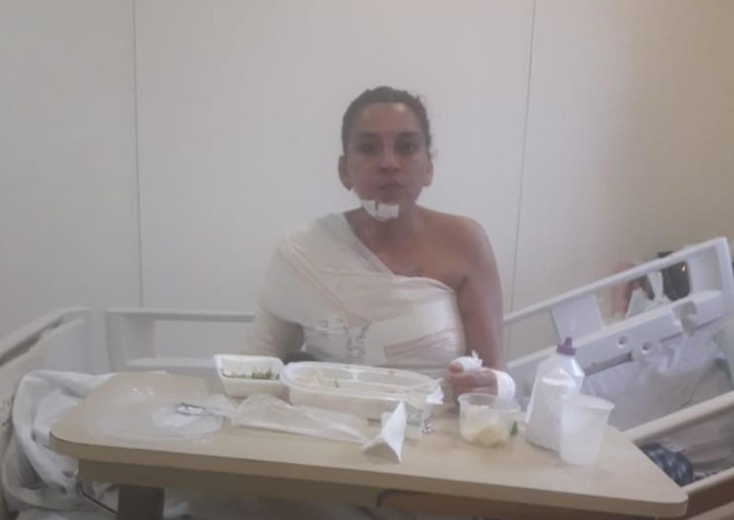 Mulher que teve 40% do corpo queimado passará por cirurgia