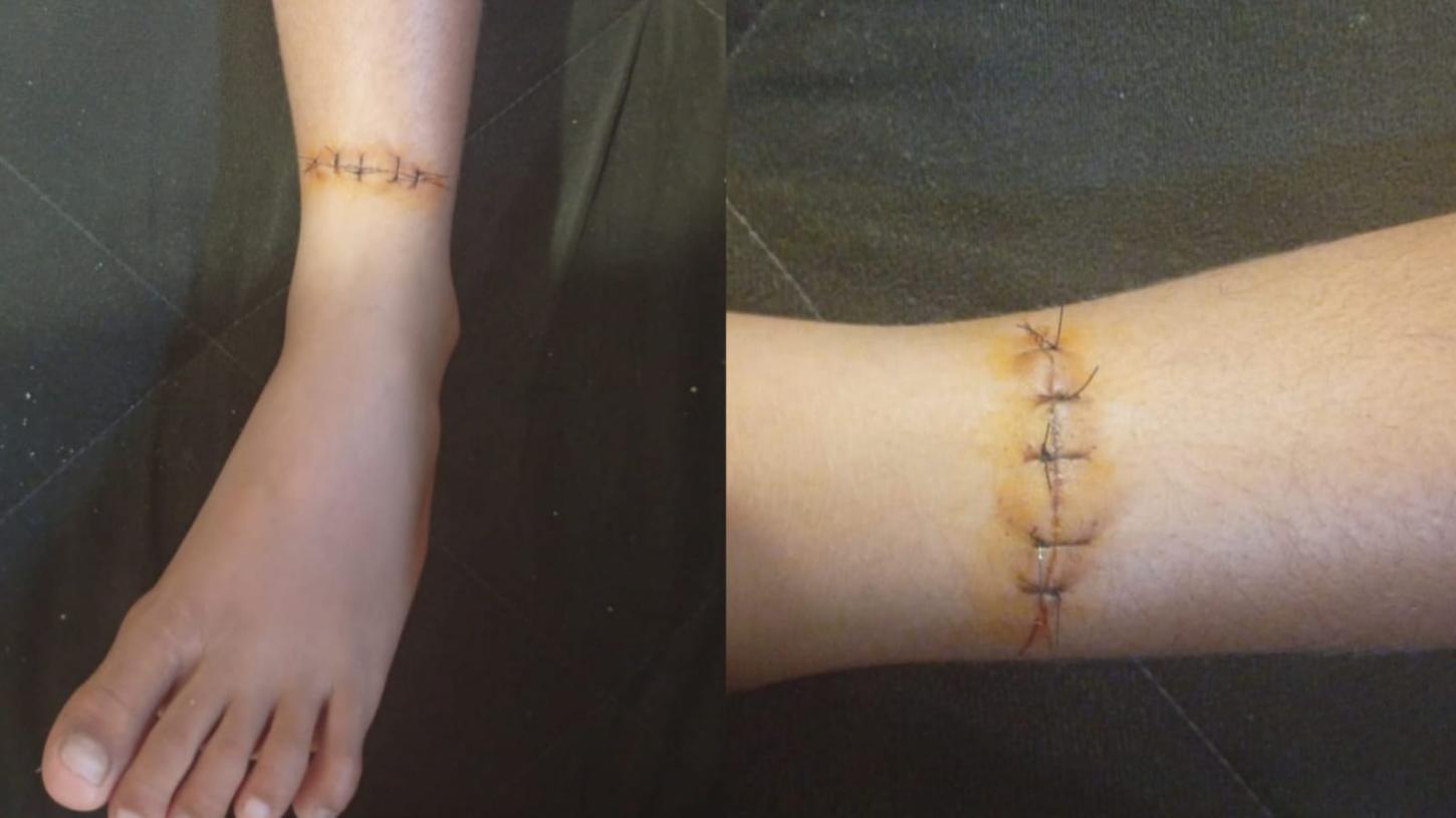 Criança fica ferida por linha de cerol durante jogo de futebol no Cambuí