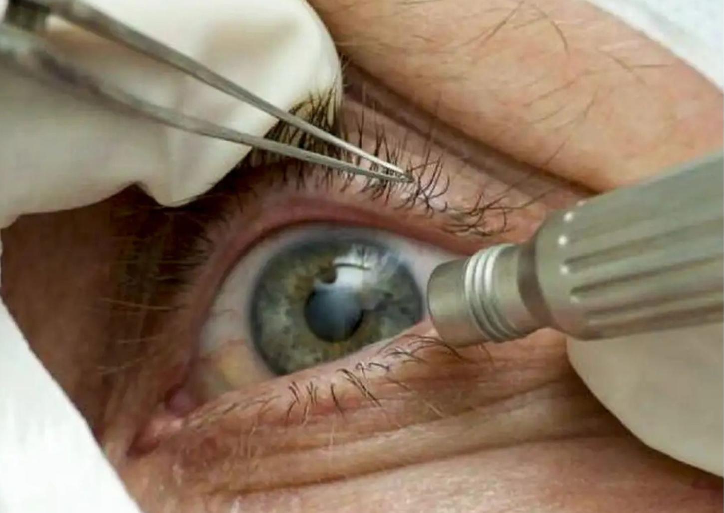 Justiça condena Santa Casa e governo de SP por mutirão que cegou pacientes